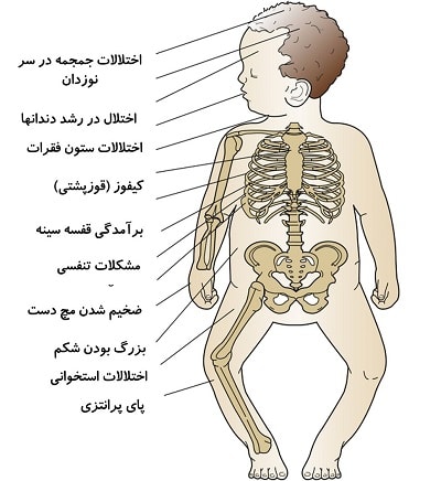 علائم نرمی استخوان یا راشیتیسم در کودکان